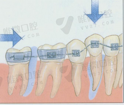 牙龈萎缩发黑怎么办（牙龈萎缩非常严重图片）(图1)